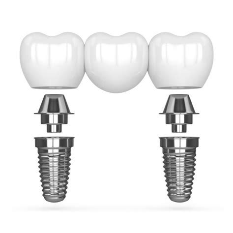 dental implants cost oklahoma city